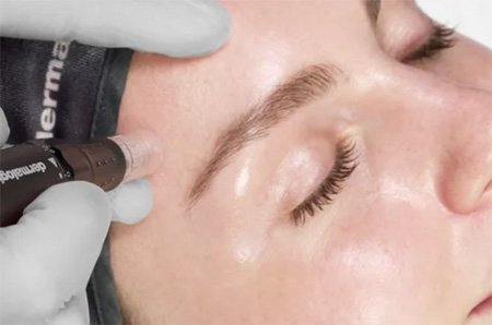 micro needling salisbury